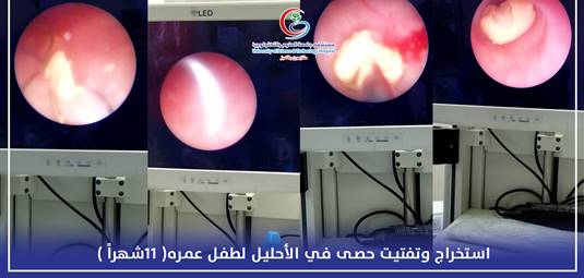  استخراج وتفتيت حصى في الإحليل لطفل عمره 11 شهراً 